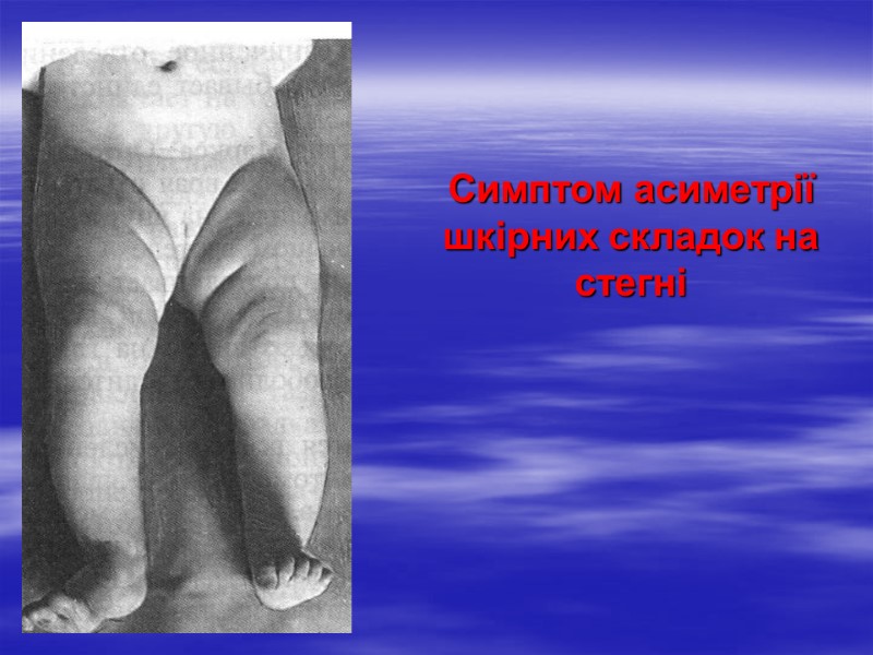 Симптом асиметрії шкірних складок на стегні